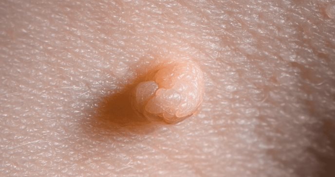 Clínica de VPH
