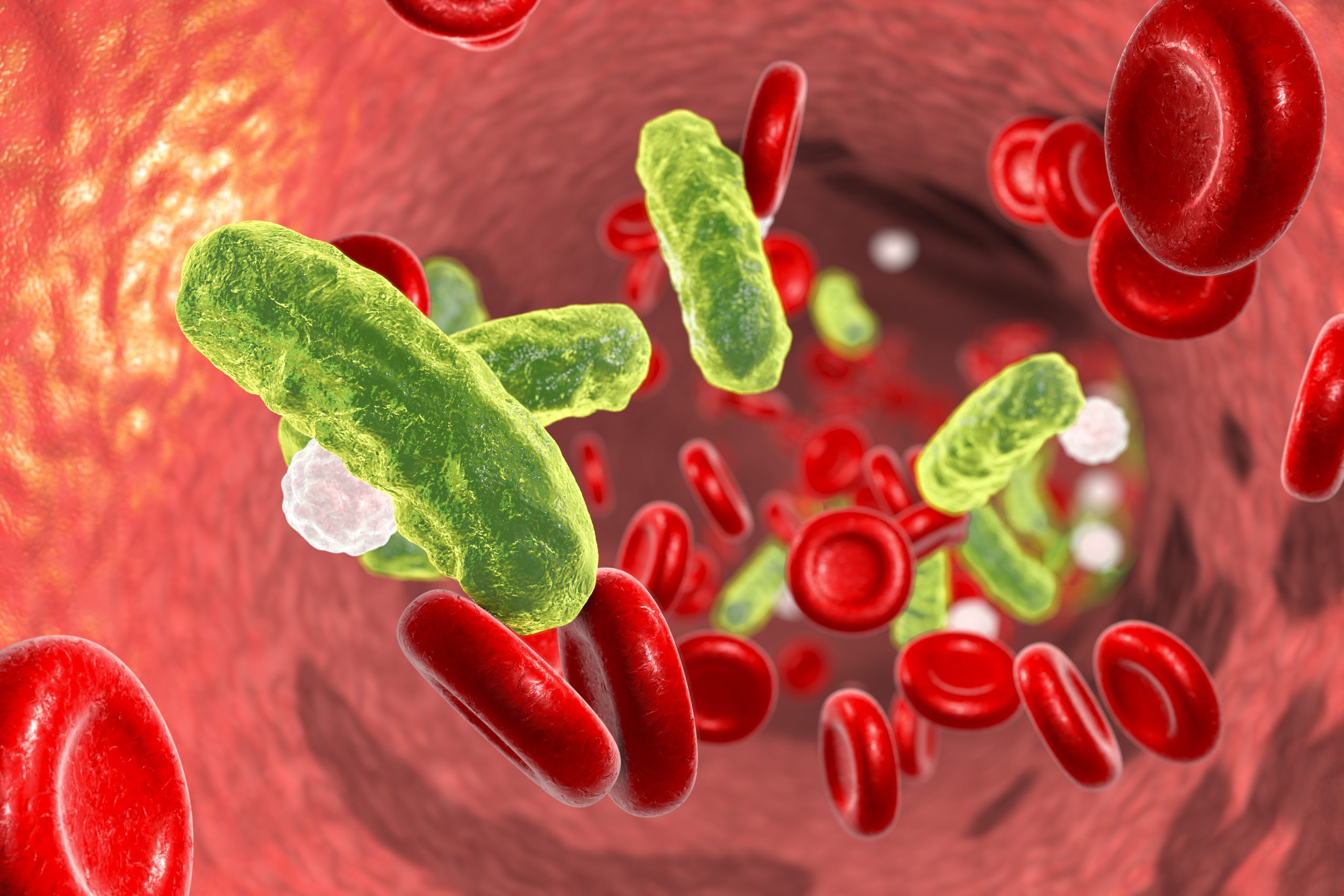 ¿Qué es la sepsis y por qué da?