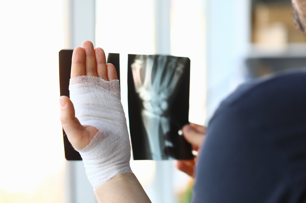 Secuelas de fractura de radio distal