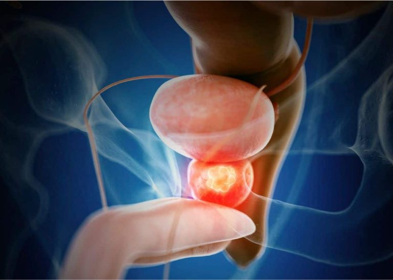 Láser de Tulio: Litos y próstata