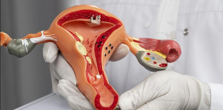 Opciones quirúrgicas de la miomatosis uterina