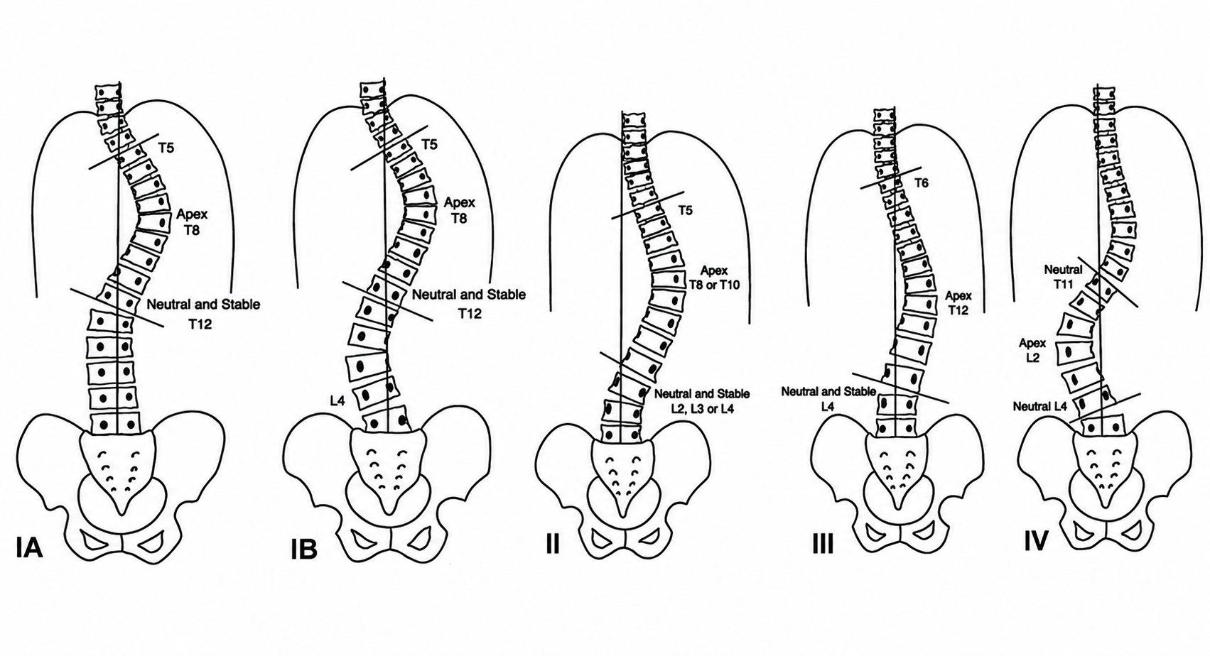 Escoliosis Idiopática